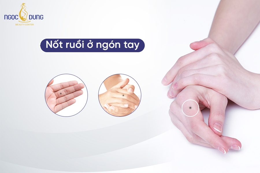 Nốt ruồi ở miệng tốt hay xấu