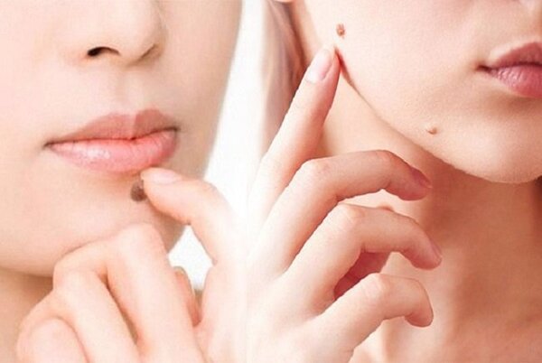 Vị trí nốt ruồi phú quý ở mặt nữ giới