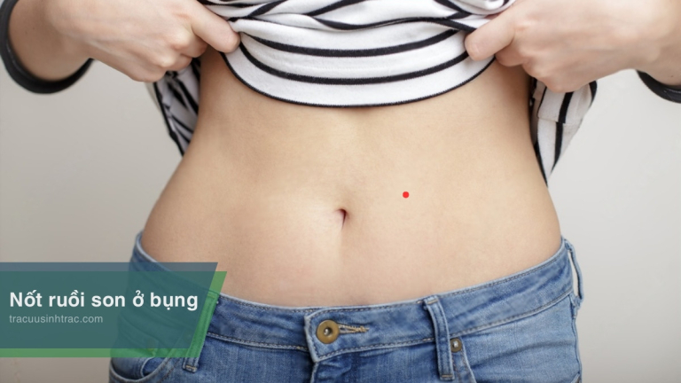 Nốt ruồi son ở bụng