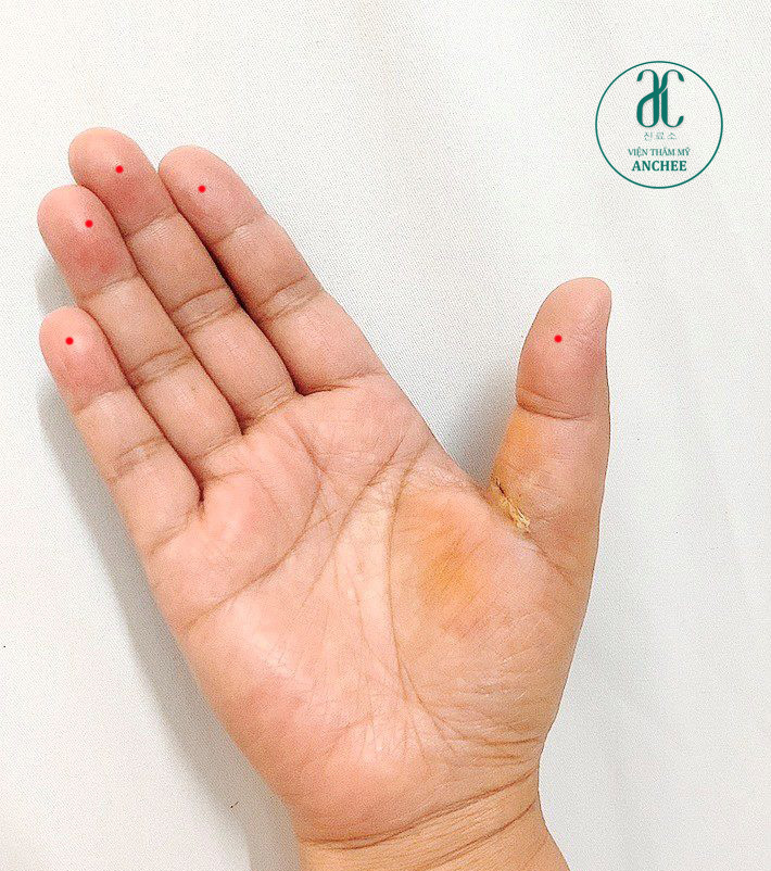 Nốt ruồi son trên ngón tay
