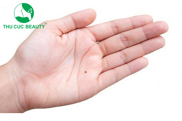 Nốt ruồi son có đem lại may mắn