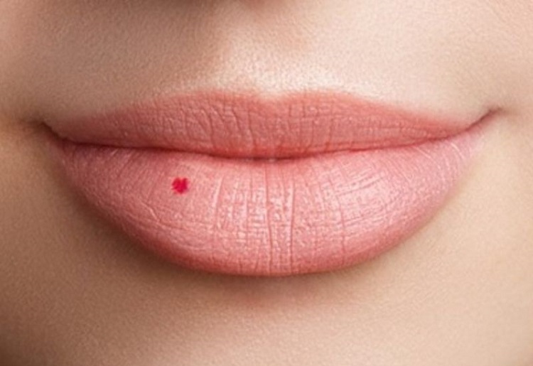 Nốt ruồi ở môi trên của nam
