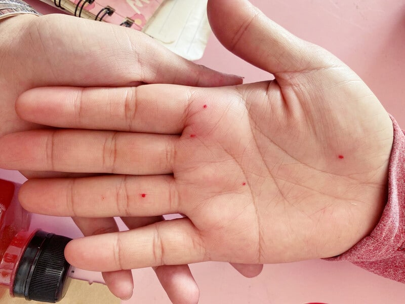 Hình ảnh nốt ruồi trong lòng bàn tay