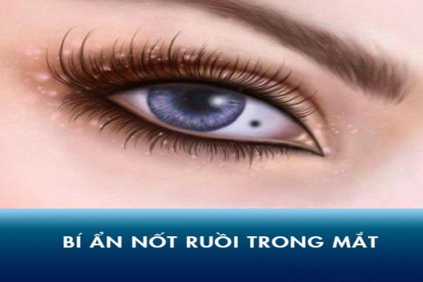 Nốt ruồi trong mắt người