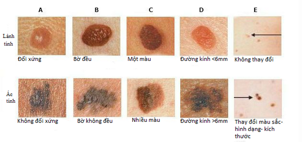 Dấu hiệu nốt ruồi bất thường trên da