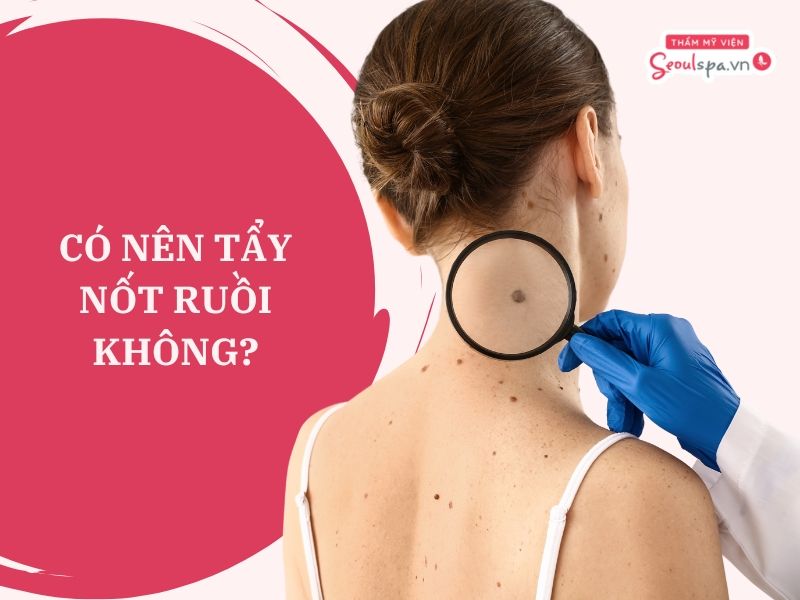 Tẩy nốt ruồi có ảnh hưởng nhân tướng không