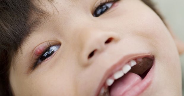 Hình ảnh trẻ nhỏ bị lẹo ở mắt