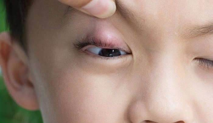 Chăm sóc trẻ bị lẹo mắt đúng cách