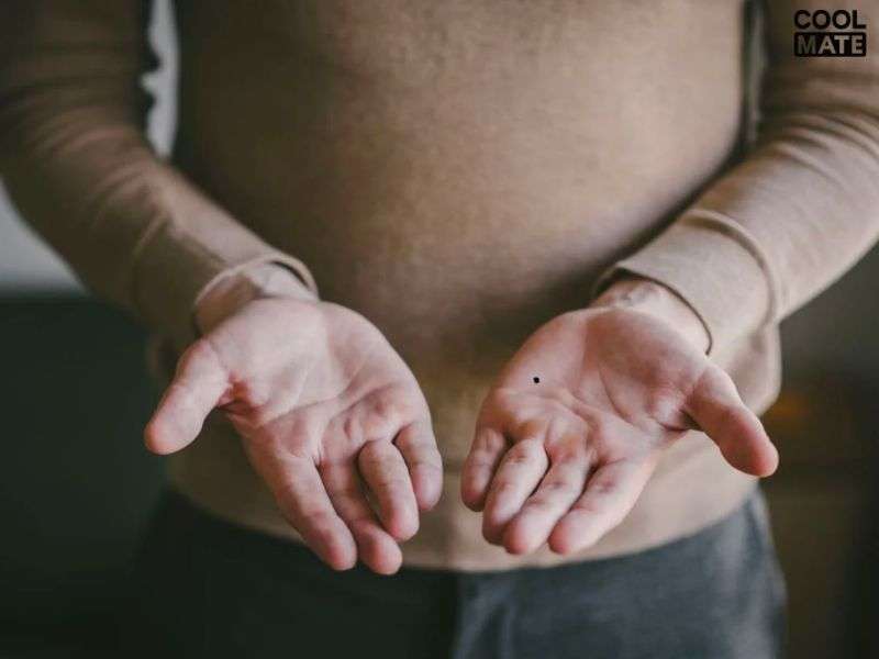 Nốt ruồi lòng bàn tay nam