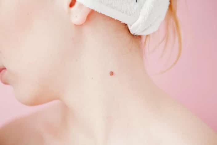 Ý nghĩa nốt ruồi son